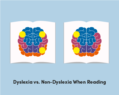 What does your dyslexic brain look like, anyway? | Dyslexia Scotland ...